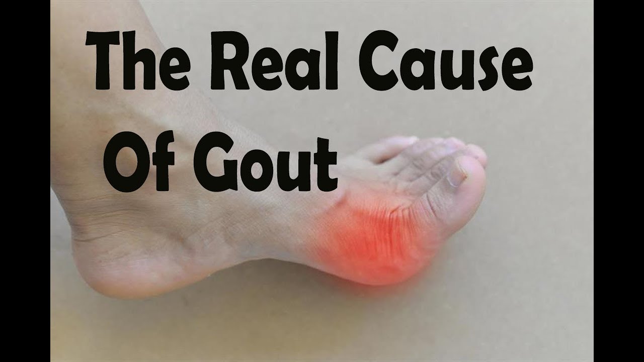 Gout The Real Cause Of Gout Uric Acid and Body Acids YouTube