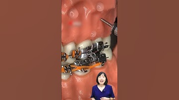 Bắt mini vít khi niềng răng có đau như lời đồn | Dr Anh Thư