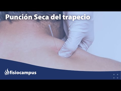 Punción seca del trapecio
