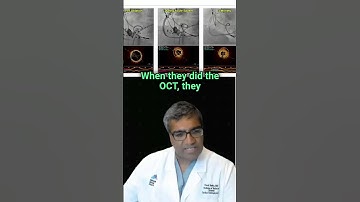 This video highlights a patient case during pulse field ablation.