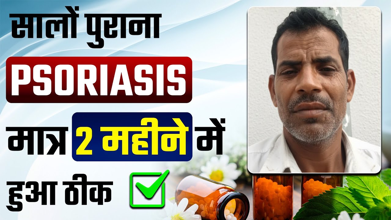 मात्र 2 महीने में सोरायसिस हुआ ठीक | Psoriasis Patient Testimonial Video | Dr. Kanchan Singh