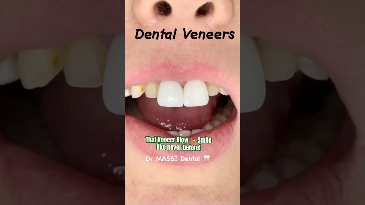 That Veneer Glow ✨ Smile like never before!