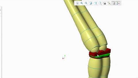 Human Knee joint, femur, tibial, cartilage meniscui Simulation by ANSYS IN BIOMECHANICS RESEARCH fea