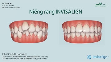 Niềng răng khấp khểnh bằng Máng trong suốt Invisalign!
