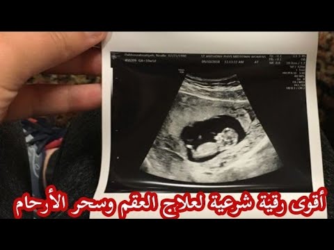 أقوى رقية شرعية للذرية لعلاج العقم وسحر الأرحام لدى الرجال والنساء و حدوث الحمل بإذن الله 