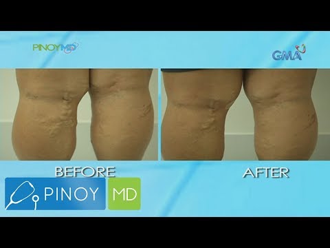 Pinoy MD: Solusyon sa varicose veins, alamin