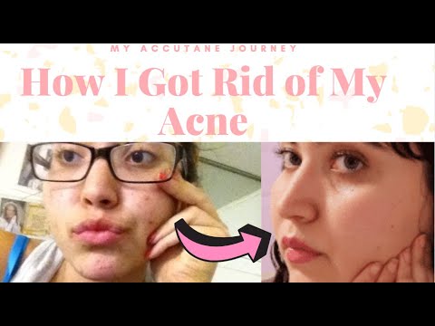 How I Got Rid of My Acne ***MY ACCUTANE JOURNEY*** - YouTube