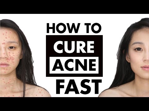 How to REALLY get rid of Pimples FAST | the Best Acne Treatment