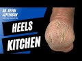 Heels Kitchen: Dry, Cracked, Callused Heel Treatment of a Food Service Worker