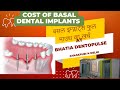       cost of basal implants costfull mouth upper archlower arch