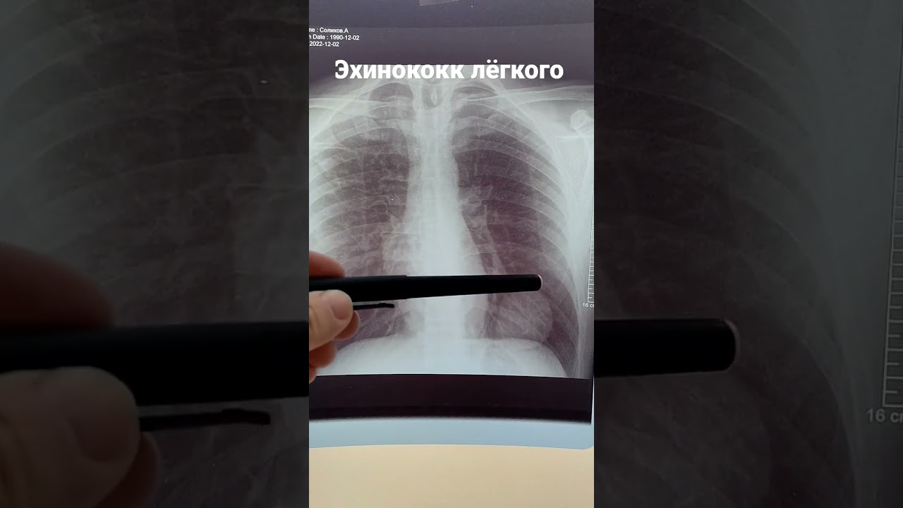 эхинококк лёгкого. рентгенограмма