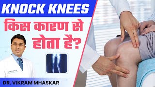 Knock Knees किस कारण से होता है | Knock Knee Problem | Vikram Mhaskar