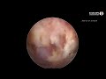 Endoscopic Spine Surgery - Dr Achal Gupta