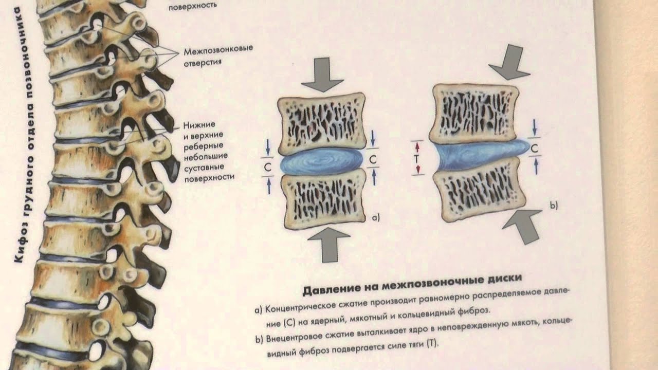 Межпозвонковая грыжа без операции