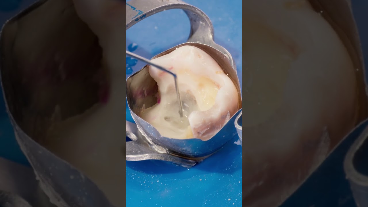 от кариеса до коронки #dentist #стоматология