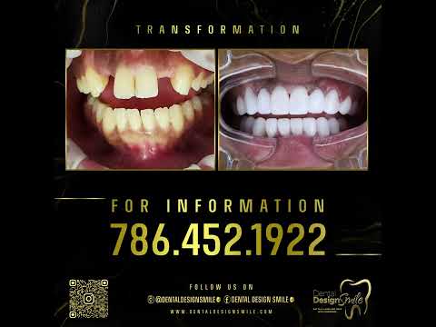 What are dental veneers? - Dental Design Smile