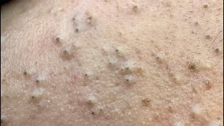 Blackhead and Pimple Removal | Korean Skincare Routine