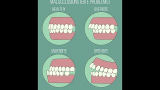 Different Types of Malocclusions