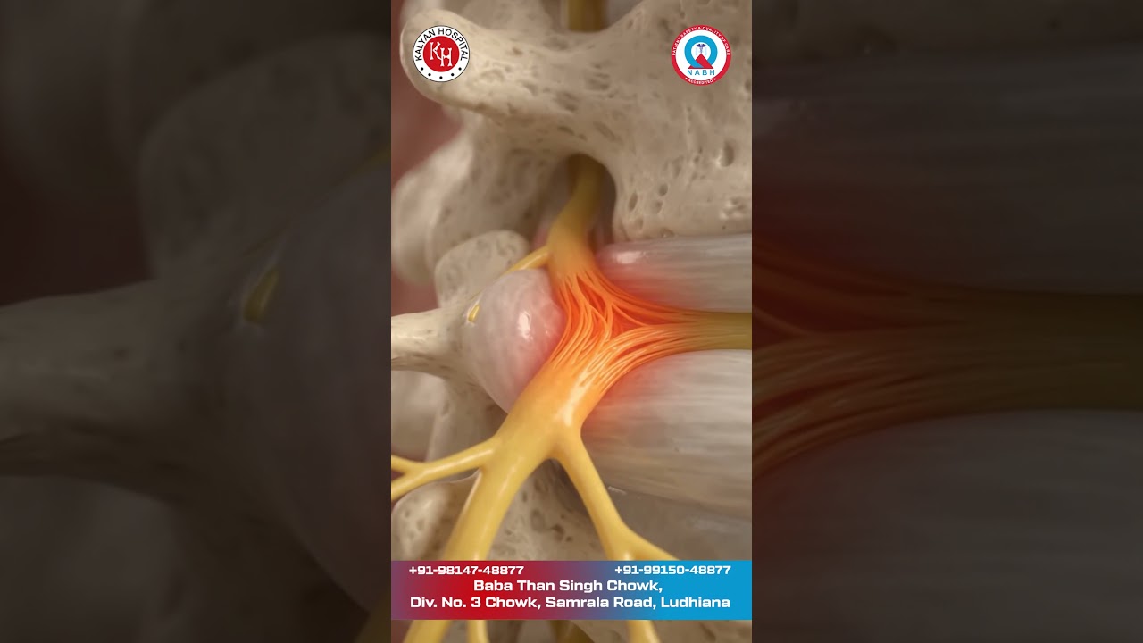 🦴 Back Pain? Explore Endoscopic Spine Surgery | Spine Care Ludhiana | Kalyan Hospital