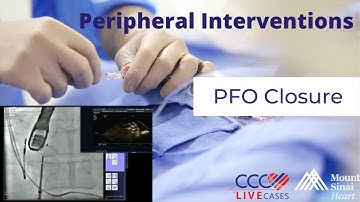 PFO Closure - December 19, 2012 Live Case Video