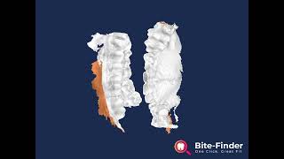 Videodocumentation: Restorative case 3-unit-bridge received with wrong bite.