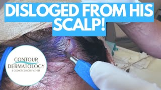 Excavating a Crater Cyst from the Scalp | CONTOUR DERMATOLOGY