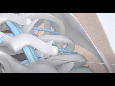 Video: Verschil Tussen Spinale En Epidurale Anesthesie