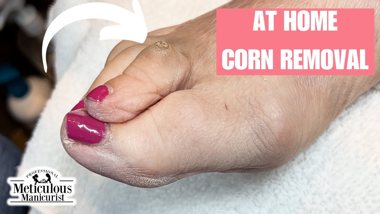 Corn Removal at Home on Toe - YouTube