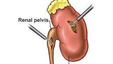 Ureterotomy CPT code - simplify medical coding