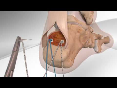 Vidéo: Comment réparer la tendinite d'Achille (avec photos)
