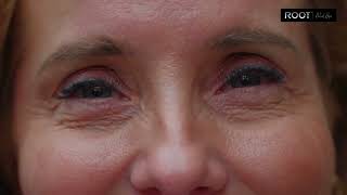 Dermal Fillers in Flower Mound & Coppell, TX | Why Does My Face Look Tired All the Time?