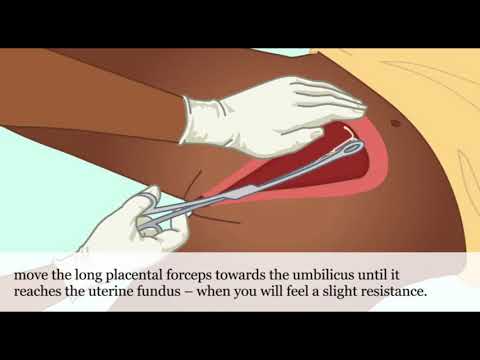 Postpartum IUD: A Practical Guide