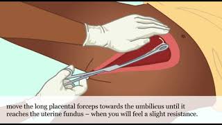 Postpartum Iud A Practical Guide