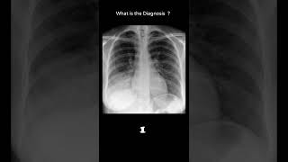 Consolidation - Right lower lobe 108 chest X-ray Quiz pulmonary disease #@radiologychannel007