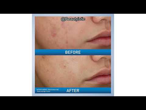 CeraVe Acne Foaming Cream Wash Review: Does 10% Benzoyl Peroxide Really Clear Acne?