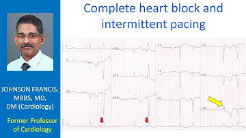 Complete heart block and intermittent pacing