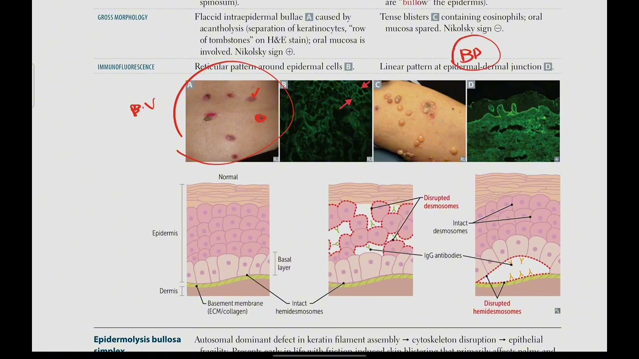 Autoimmune blistering skin disorders | Dermatology # 5 | First Aid USMLE in Urdu/Hindi