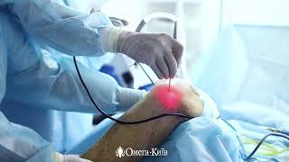 Артроскопия коленного сустава в Киеве, цена, как проводится операция, сколько длится – Омега-Киев