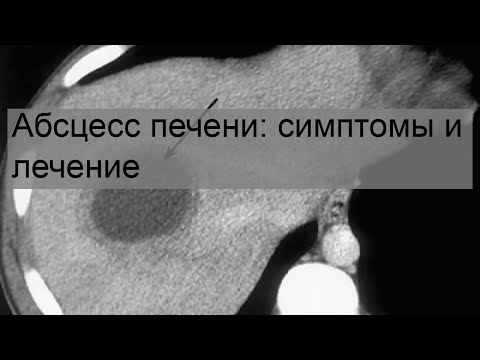 Абсцесс печени: симптомы и лечение