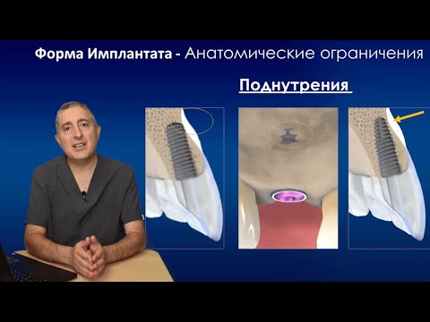 Различия между имплантатами  или Чем отличаются импланты (форма)