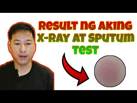 🔴 Nakuha ko na ang result ng aking X-ray at Sputum Test!