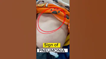 Danger Signs In Pneumonia Pneumonia Signs 
