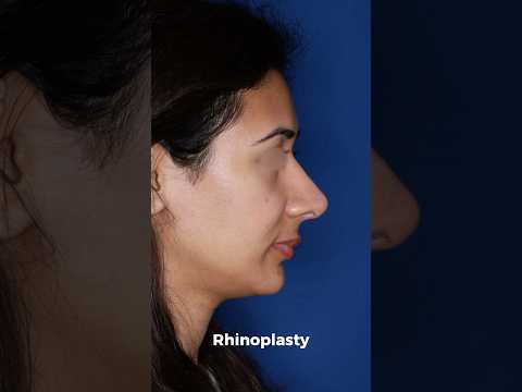 Video thumbnail: Her Biggest Concern: A Straighter Bridge | 10 Months Post Rhinoplasty by Dr. Stong · Kalos Facial Plastic Surgery
