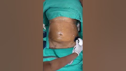 Abdomen Liposuction result | RF Session #shorts