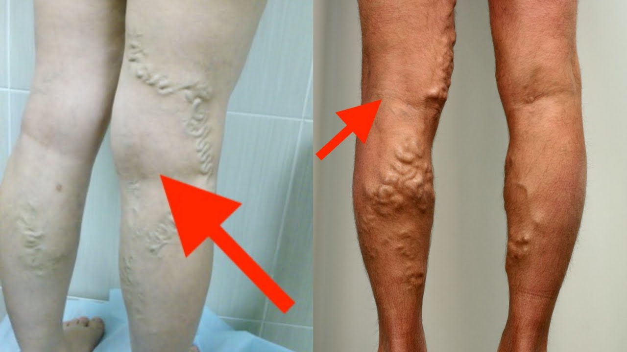 ВАРИКОЗ: как избавиться от варикоза вен без операции? - YouTube