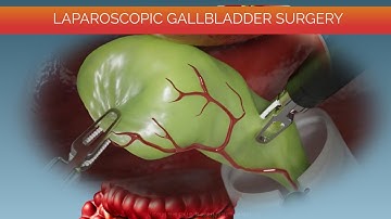 Laparoscopic Gallbladder Surgery - Cholecystectomy Procedure// Gallbladder Removal animation