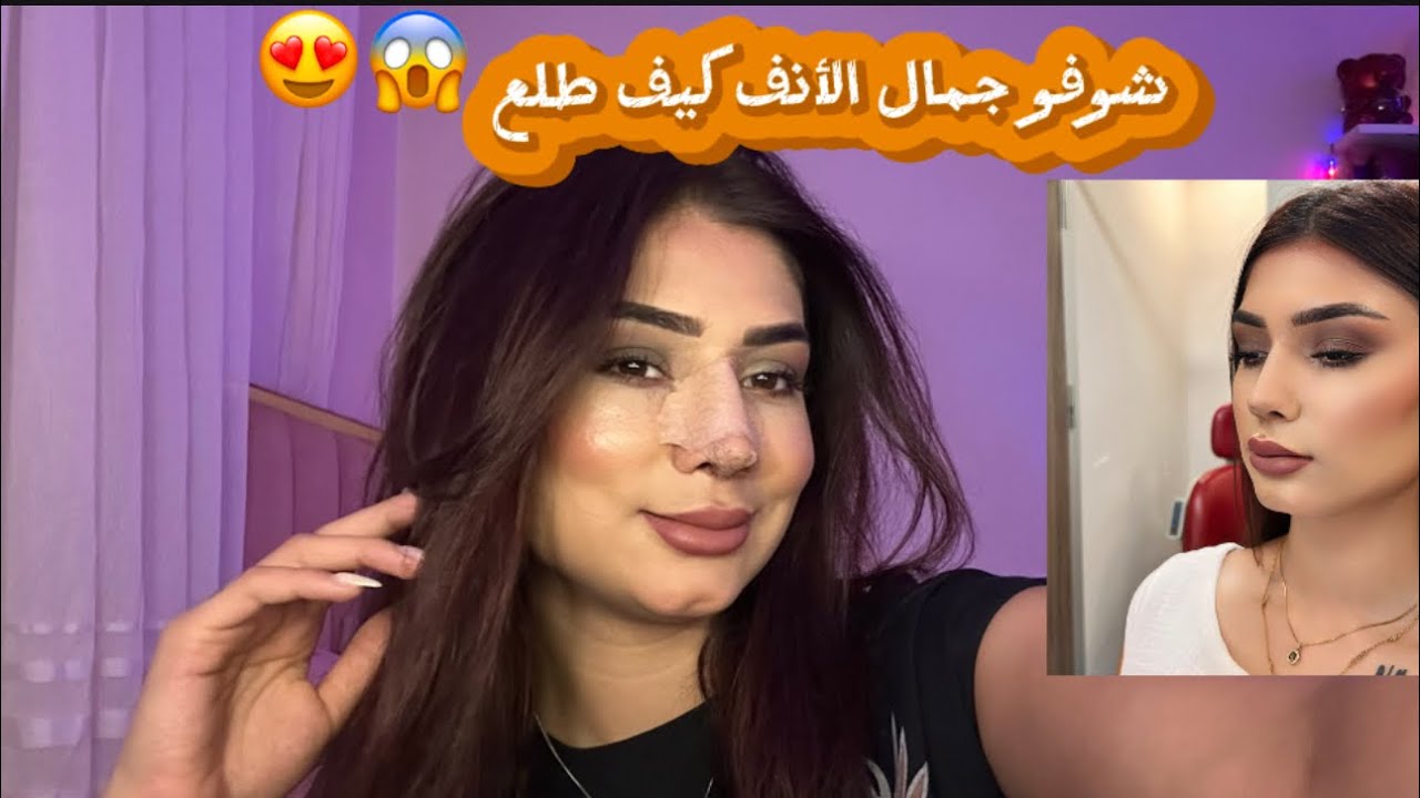 نتيجة عملية الأنف واخيراً 😍😱النتيجة صدمتني🔥