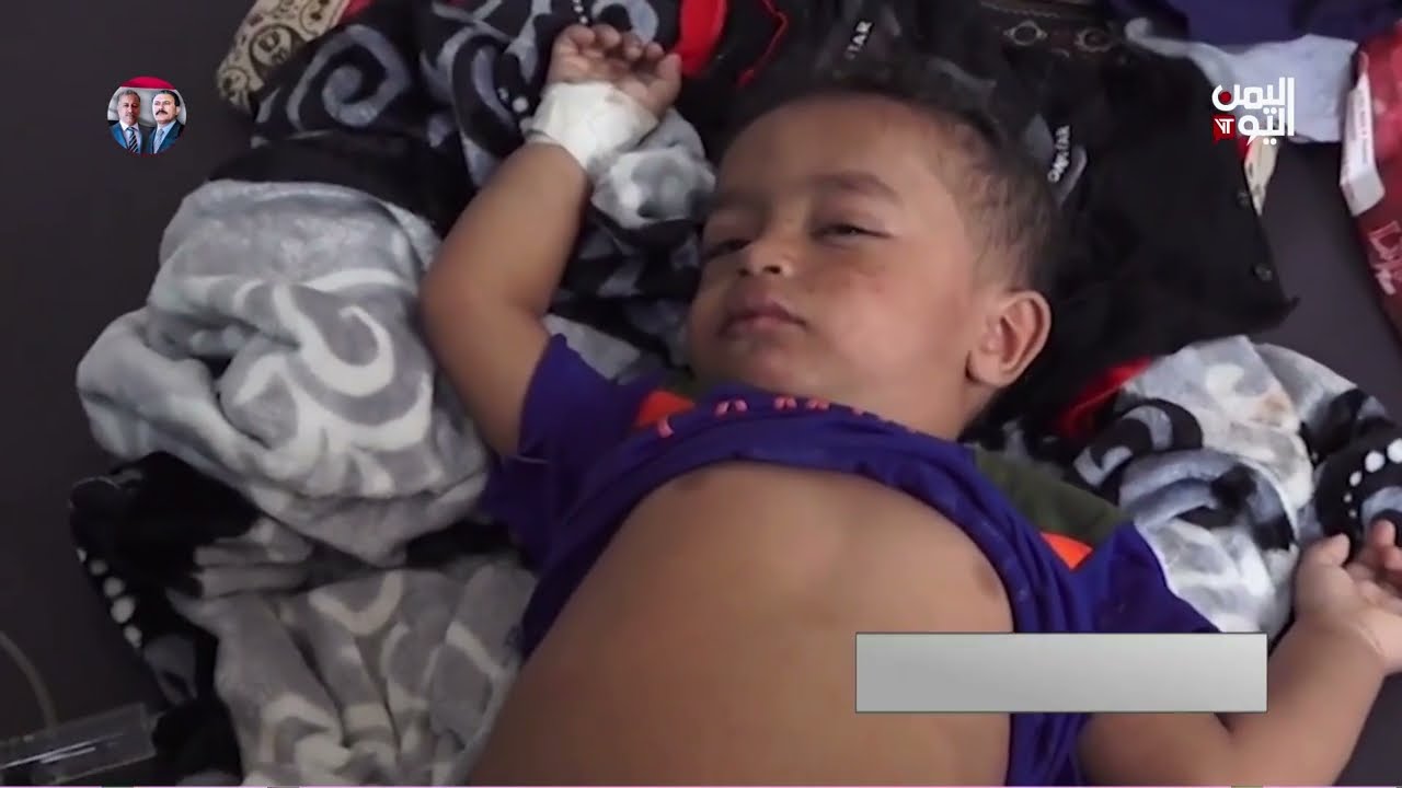 تسجيل 300 إصابة بشلل أطفال. والحكومة تنفذ حملة تحصين جديدة | تقرير أمجد جلال