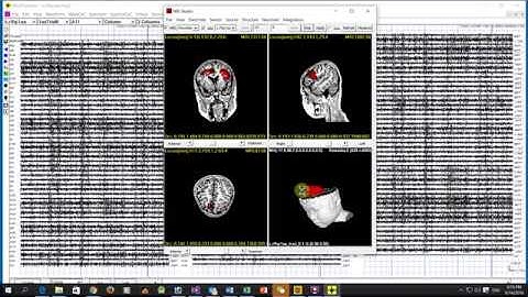 Visualize MEG Sources (Brain Activation and Activity)