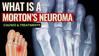 Podiatrist Breaks Down Mortons Neuroma And What Actually Helps